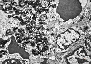 M, 6m. | Niemann-Pick disease - spleen M, 6m. | Niemann-Pick disease - spleen